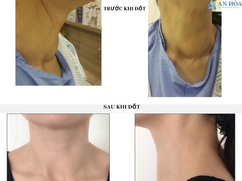 Đốt Sóng Cao Tần RFA