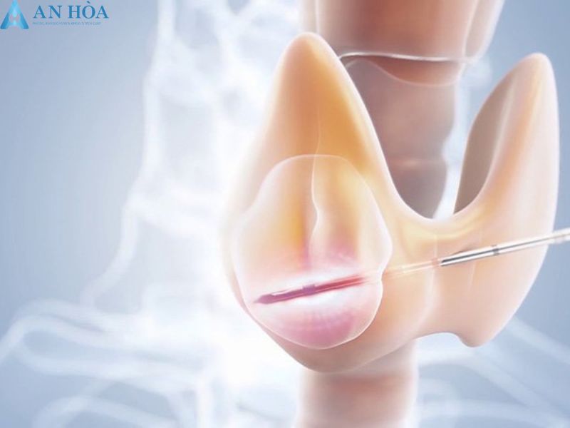 Đốt Sóng Cao Tần RFA 