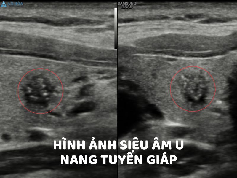 Bị nang tuyến giáp có nguy hiểm không