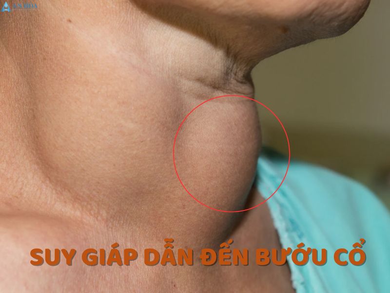 Biến chứng suy tuyến giáp