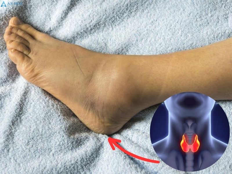 Biến chứng suy tuyến giáp