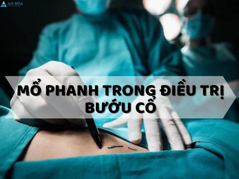 Bướu cổ lành tính có nên mổ không