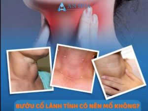 Bướu cổ lành tính có nên mổ không