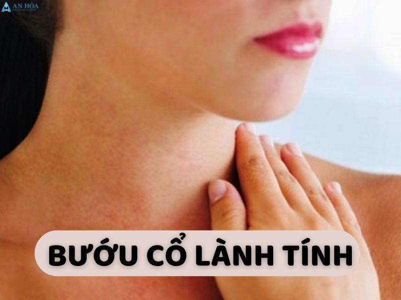 Bướu cổ lành tính có nên mổ không