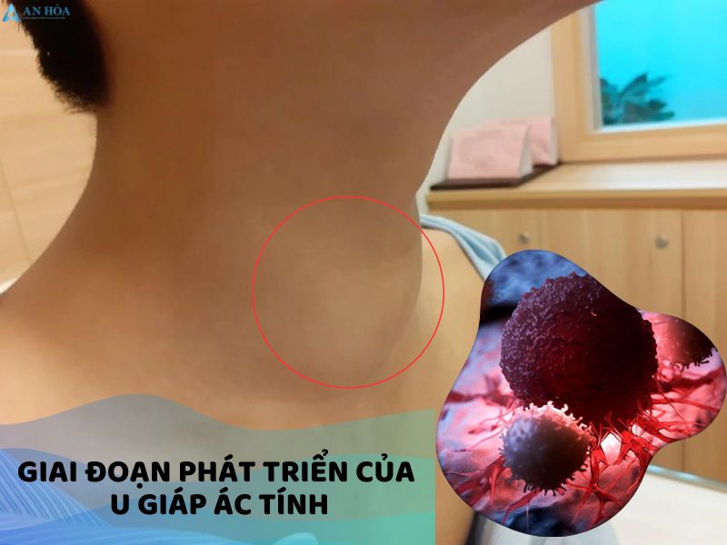 U ác tuyến giáp có phải là ung thư không