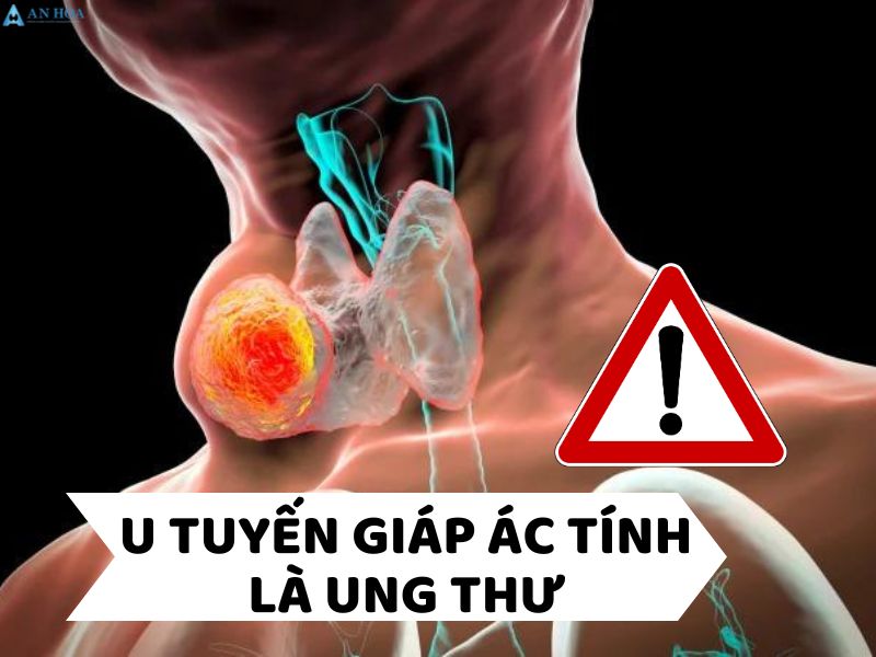 U ác tuyến giáp có phải là ung thư không