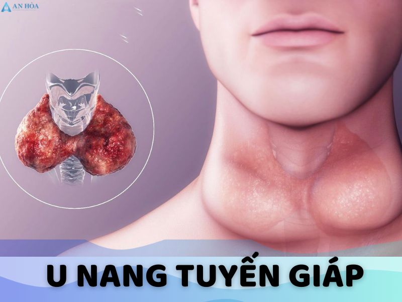 Bị nang tuyến giáp có nguy hiểm không?