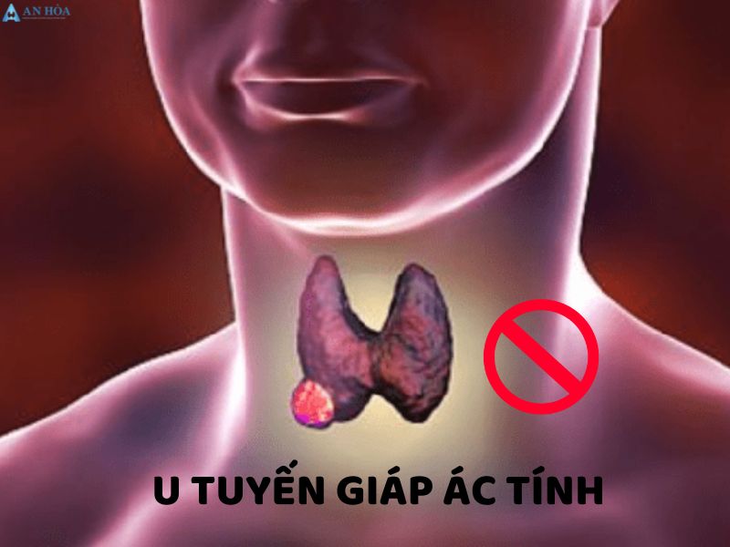 U ác tuyến giáp có phải là ung thư không