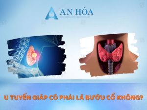 U tuyến giáp có phải là bướu cổ không