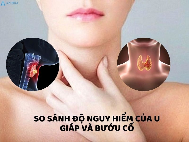 U tuyến giáp có phải là bướu cổ không