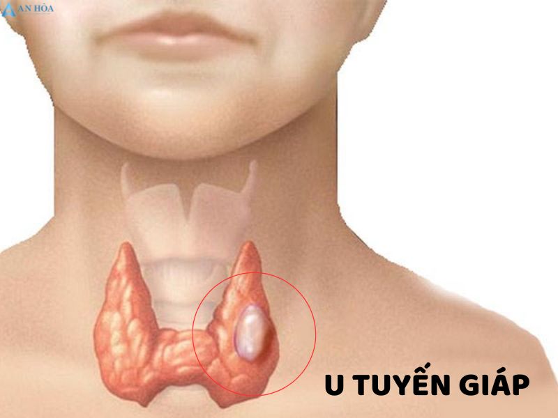 U tuyến giáp có phải là bướu cổ không