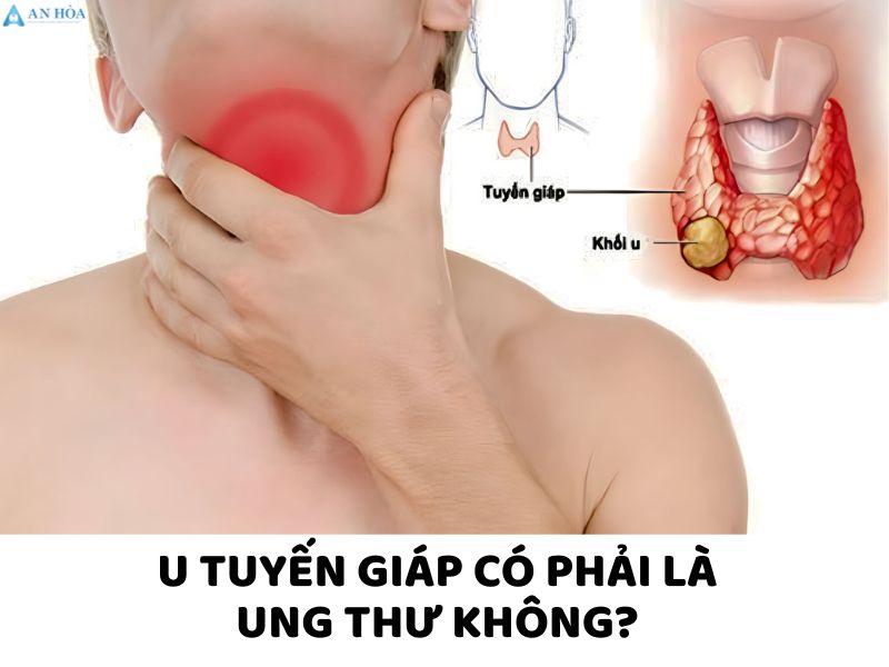 U tuyến giáp có phải là ung thư không
