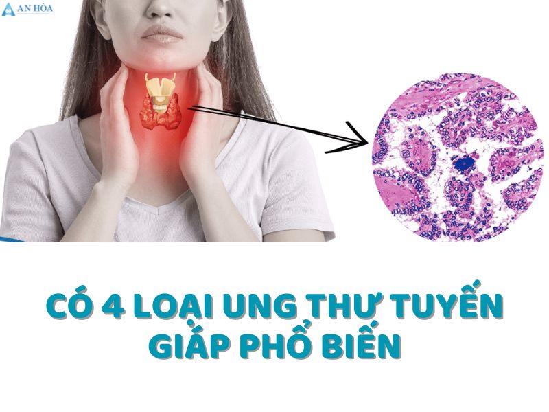 U tuyến giáp có phải là ung thư không