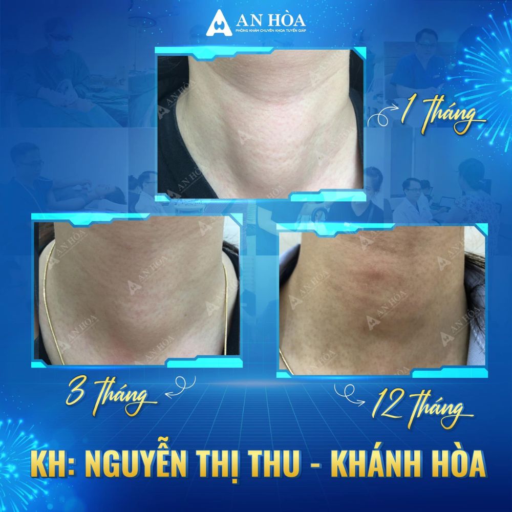 Đốt Sóng Cao Tần RFA